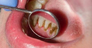 جرم گیری ضرر داره؟